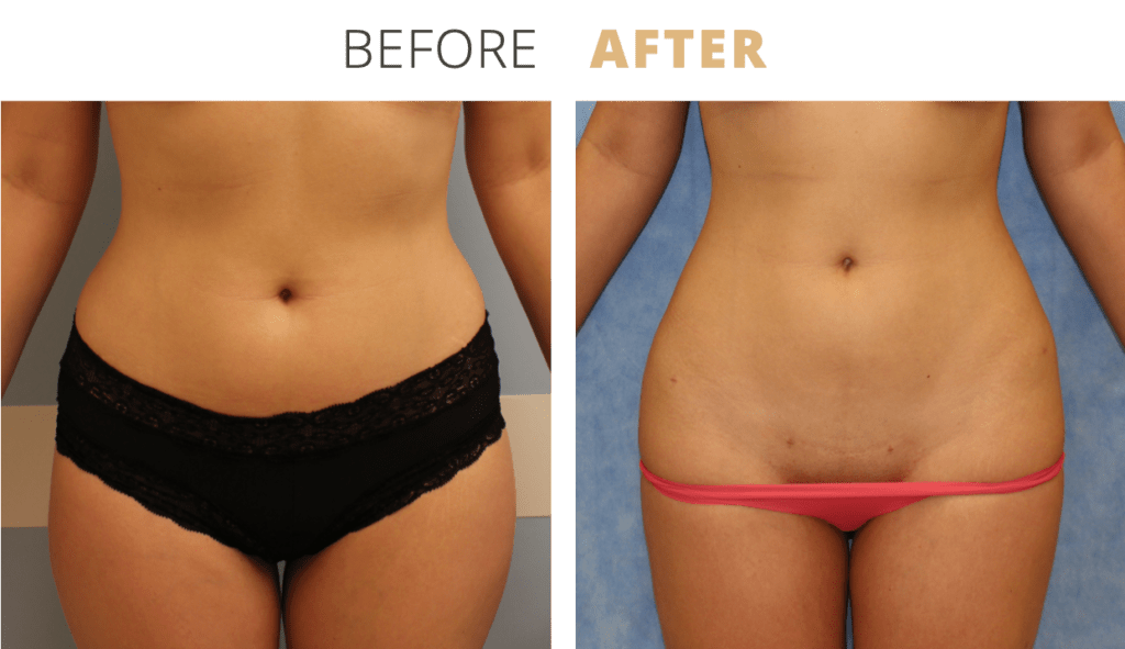 Body-Liposuction4-1-1024x591