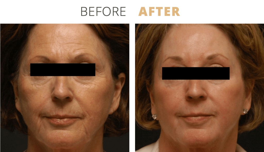 Face-ChemicalPeeling1-1024x591