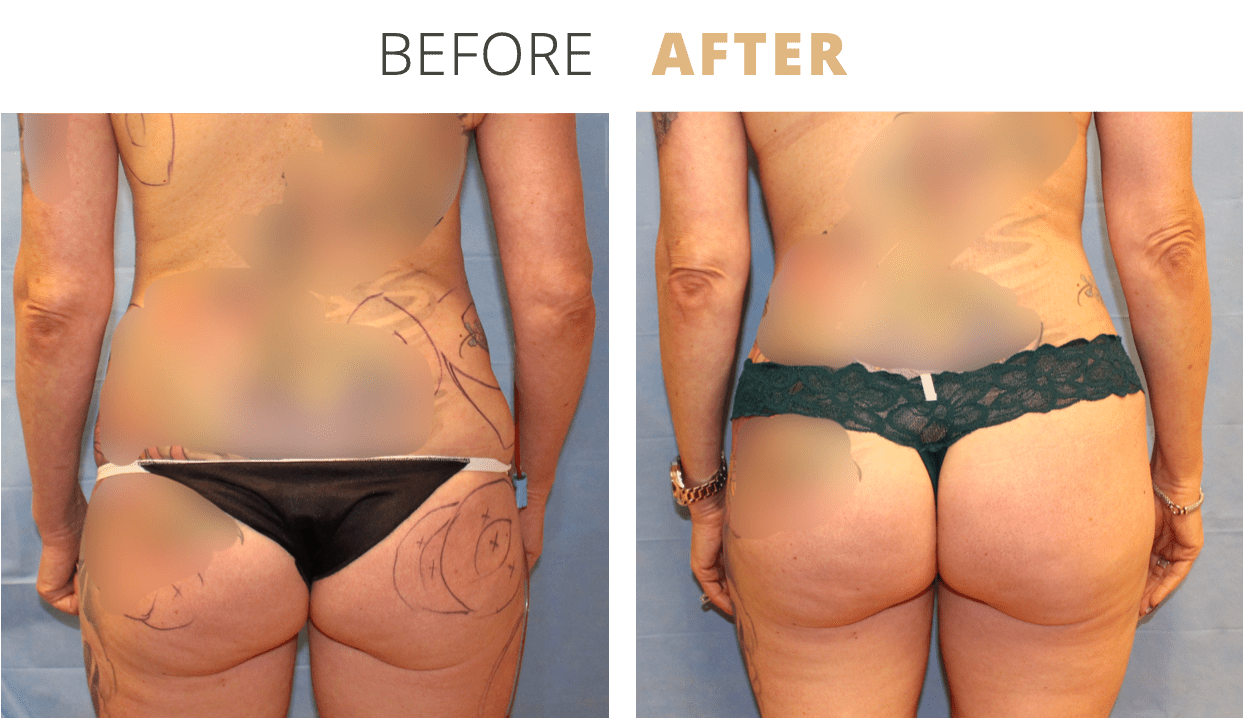 Body-FatTransfertoButtocksBrazilianButtLift1