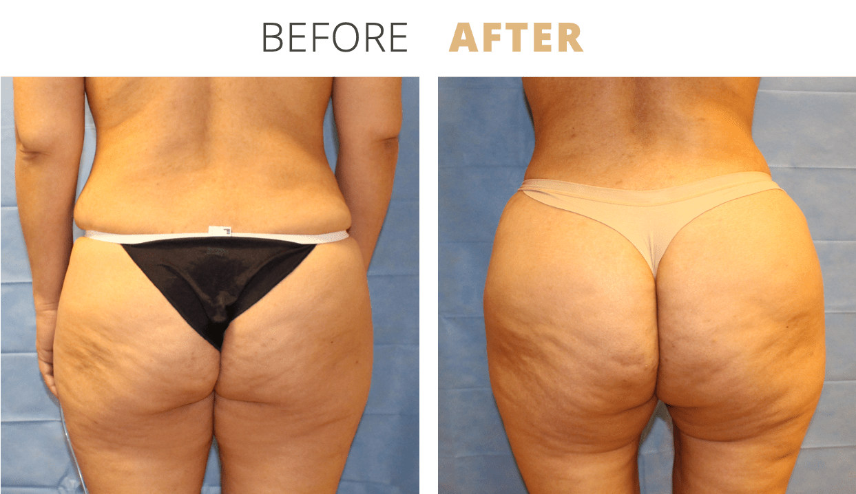 Body-FatTransfertoButtocksBrazilianButtLift3