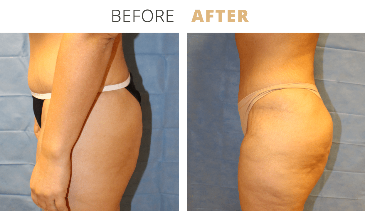 Body-FatTransfertoButtocksBrazilianButtLift4
