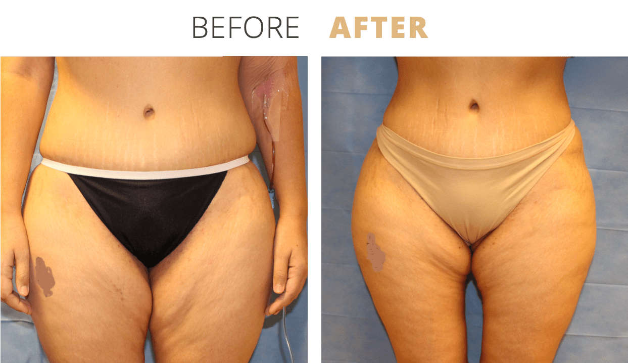 Body-FatTransfertoButtocksBrazilianButtLift5