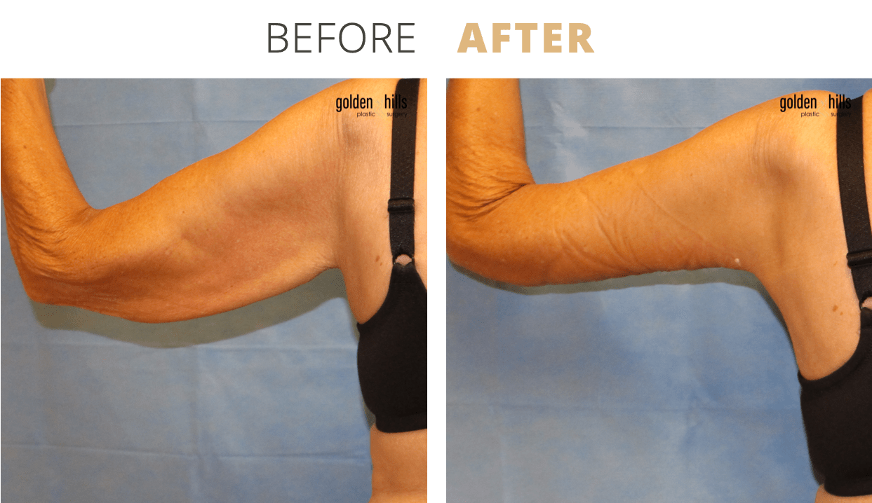 Body-Arm+Lift+(Brachioplasty)1