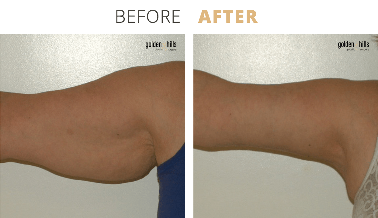 Body-Arm+Lift+(Brachioplasty)2