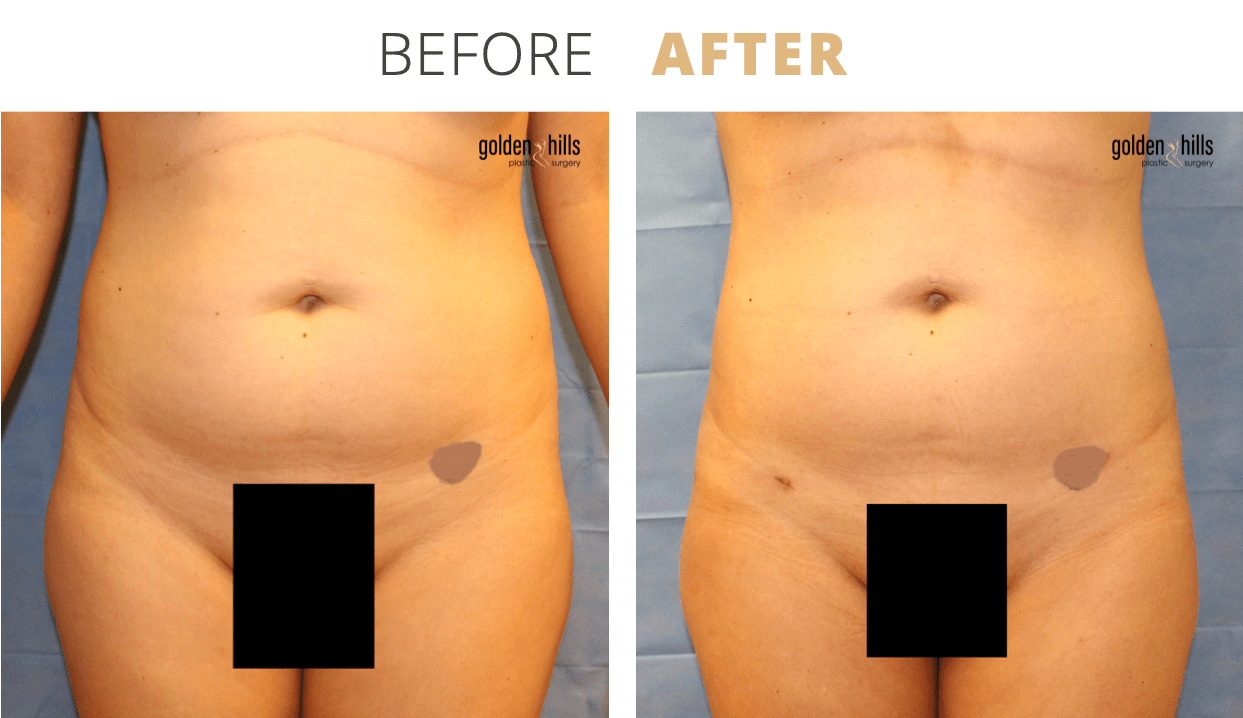 Body-Liposuction1