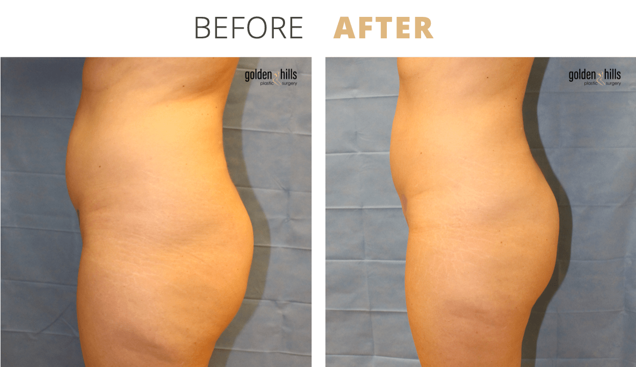 Body-Liposuction2