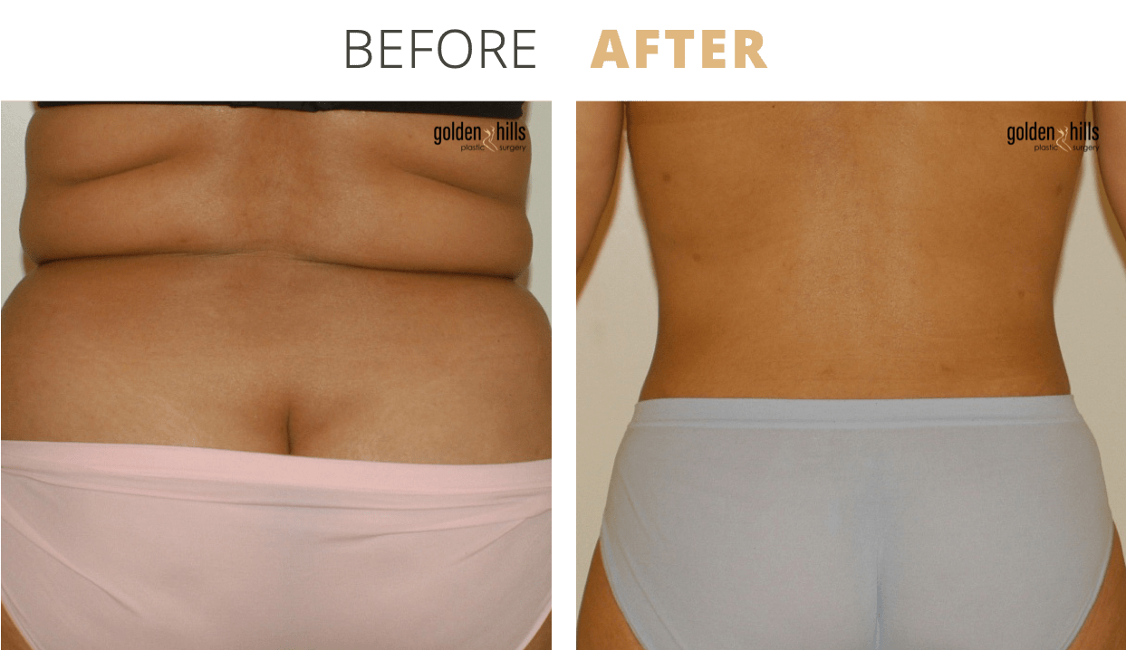 Body-Liposuction3