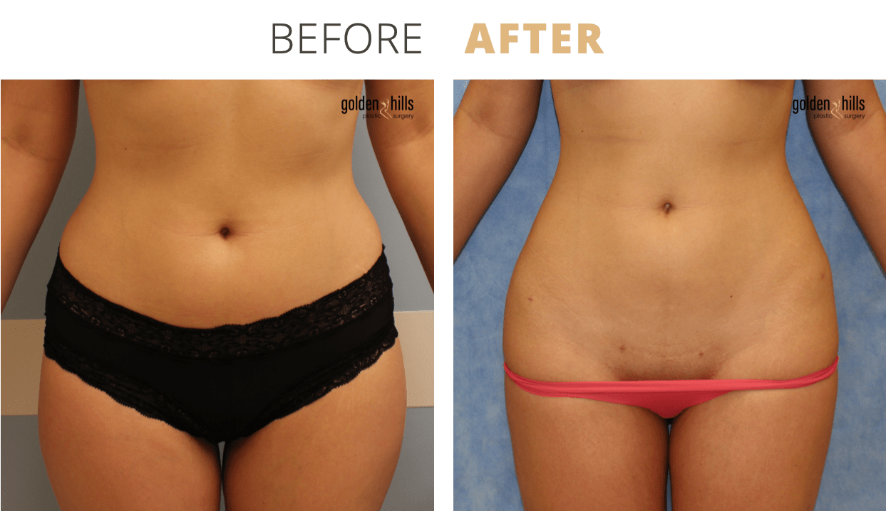 Body-Liposuction4