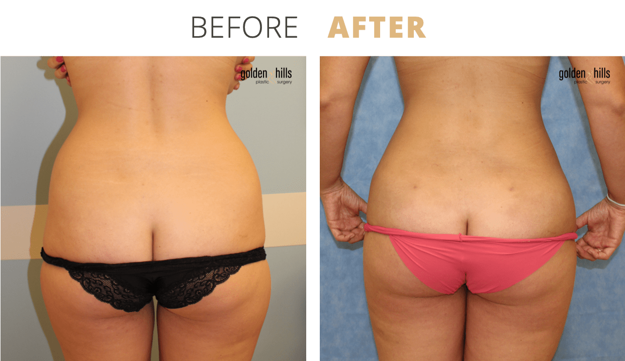 Body-Liposuction5