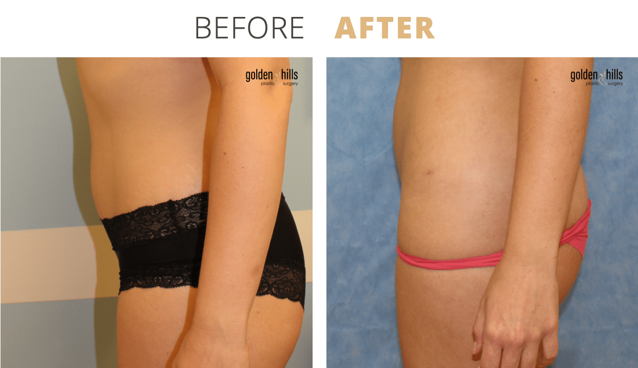 Body-Liposuction6