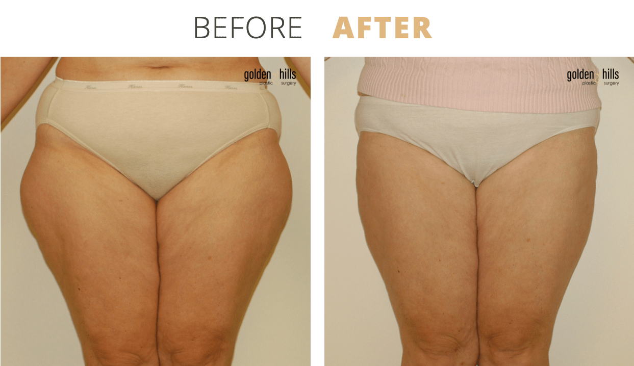Body-Liposuction7