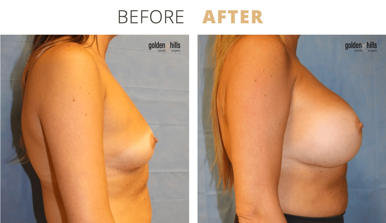 Breast-Breast+Augmentation10