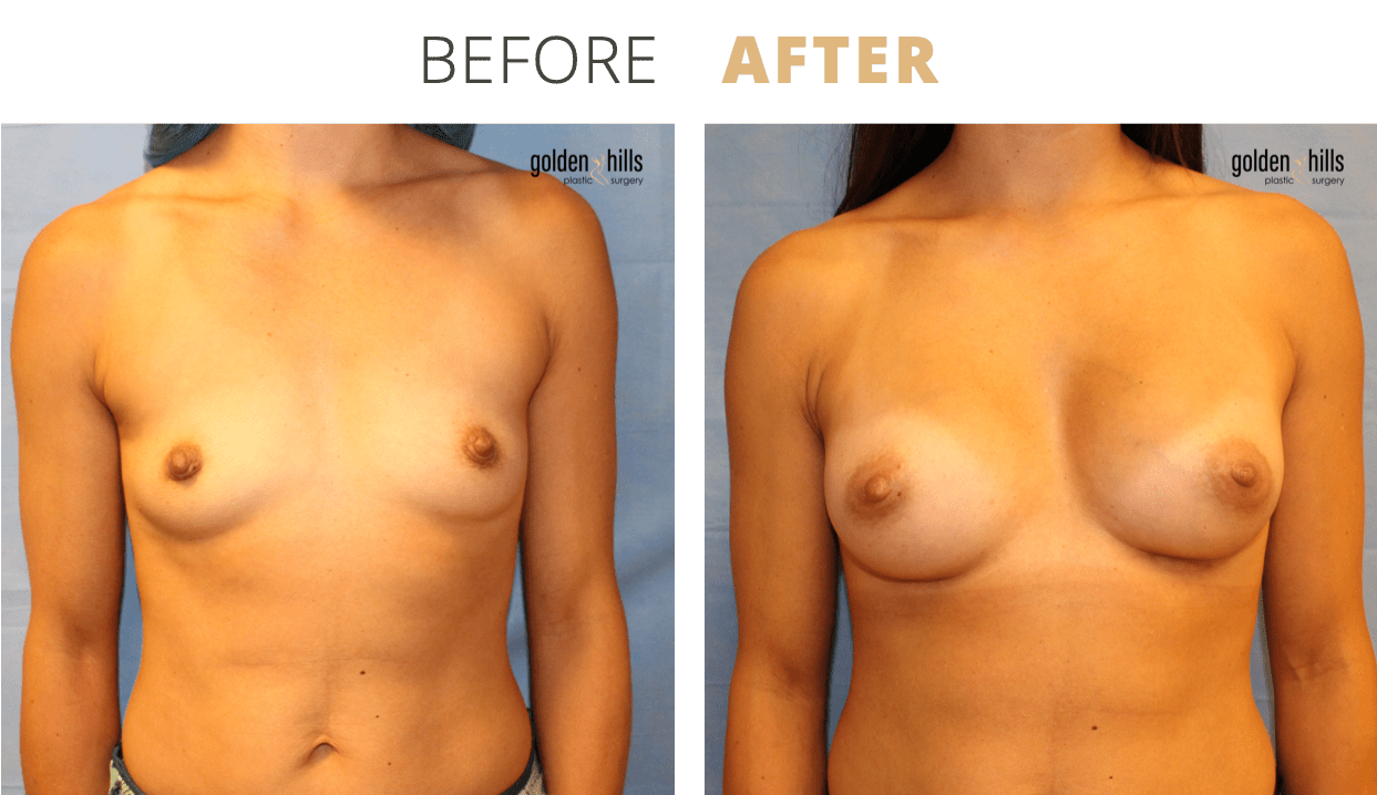 Breast-Breast+Augmentation3