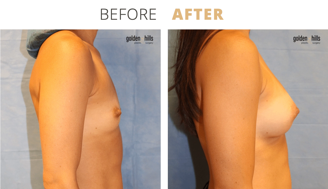 Breast-Breast+Augmentation4