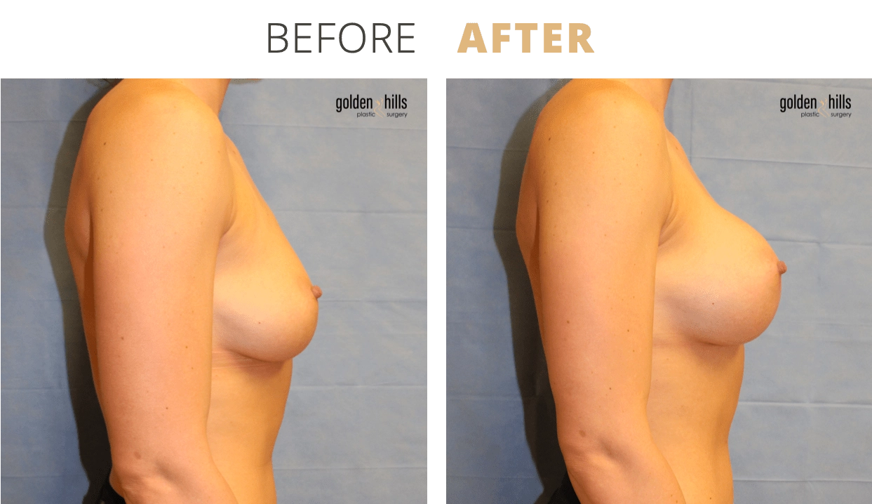 Breast-Breast+Augmentation5