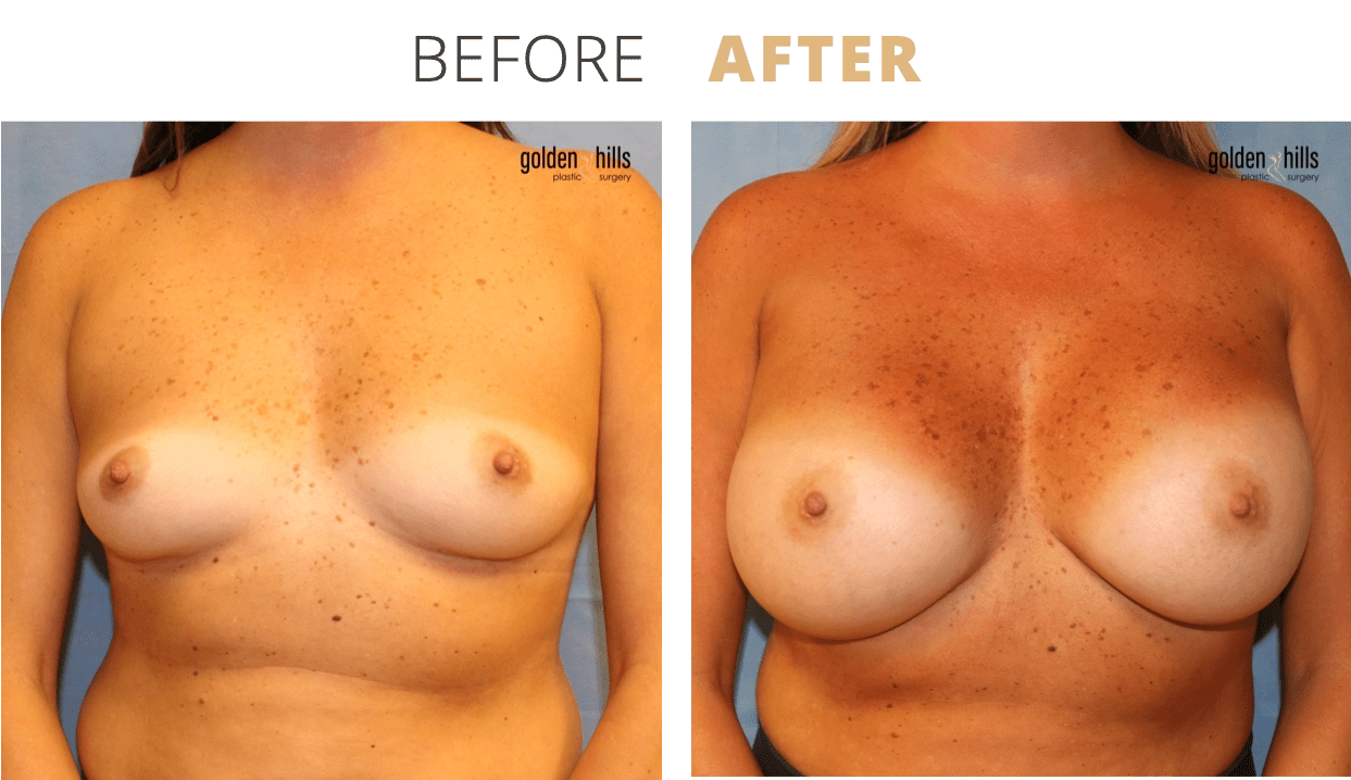 Breast-Breast+Augmentation9