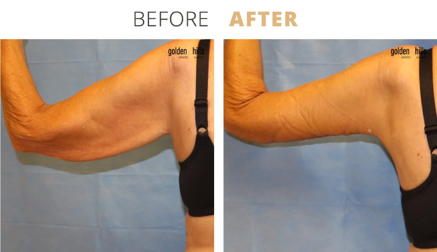 Body Arm Lift (Brachioplasty)