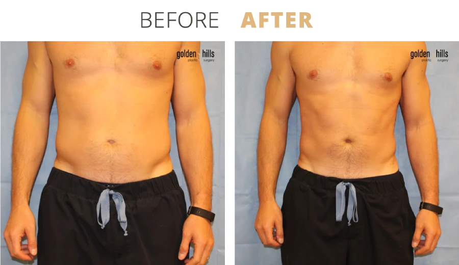 Emsculpt, For Men Abdominal
