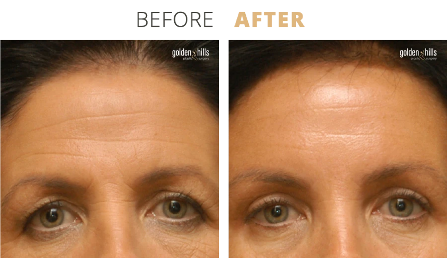 Face Browlift