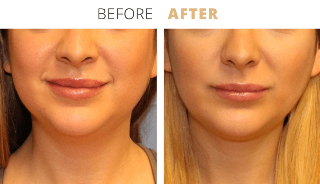 Face-Necklift9-1024x591 (1)