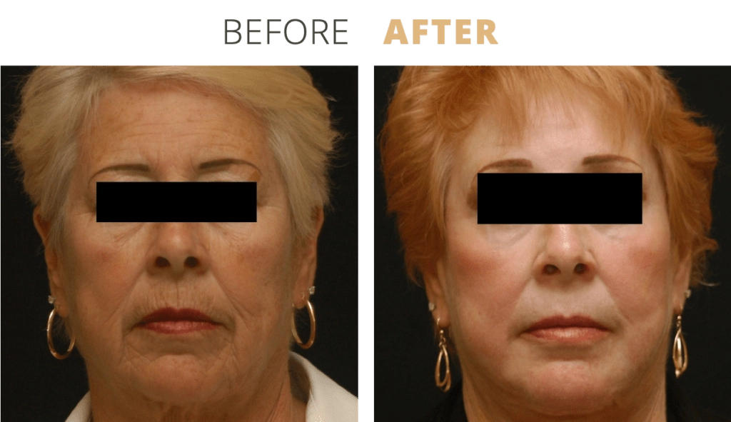 Face-ChemicalPeeling4-1024x591