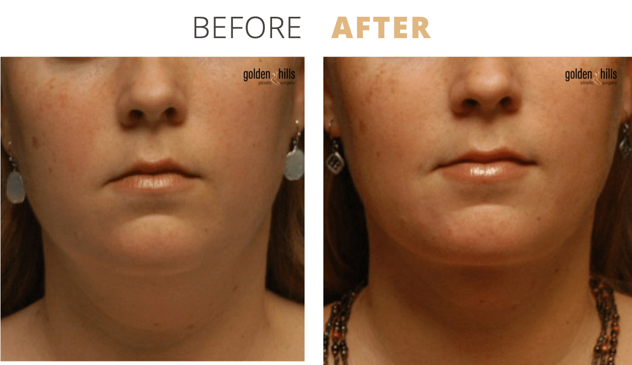 Face-Necklift5
