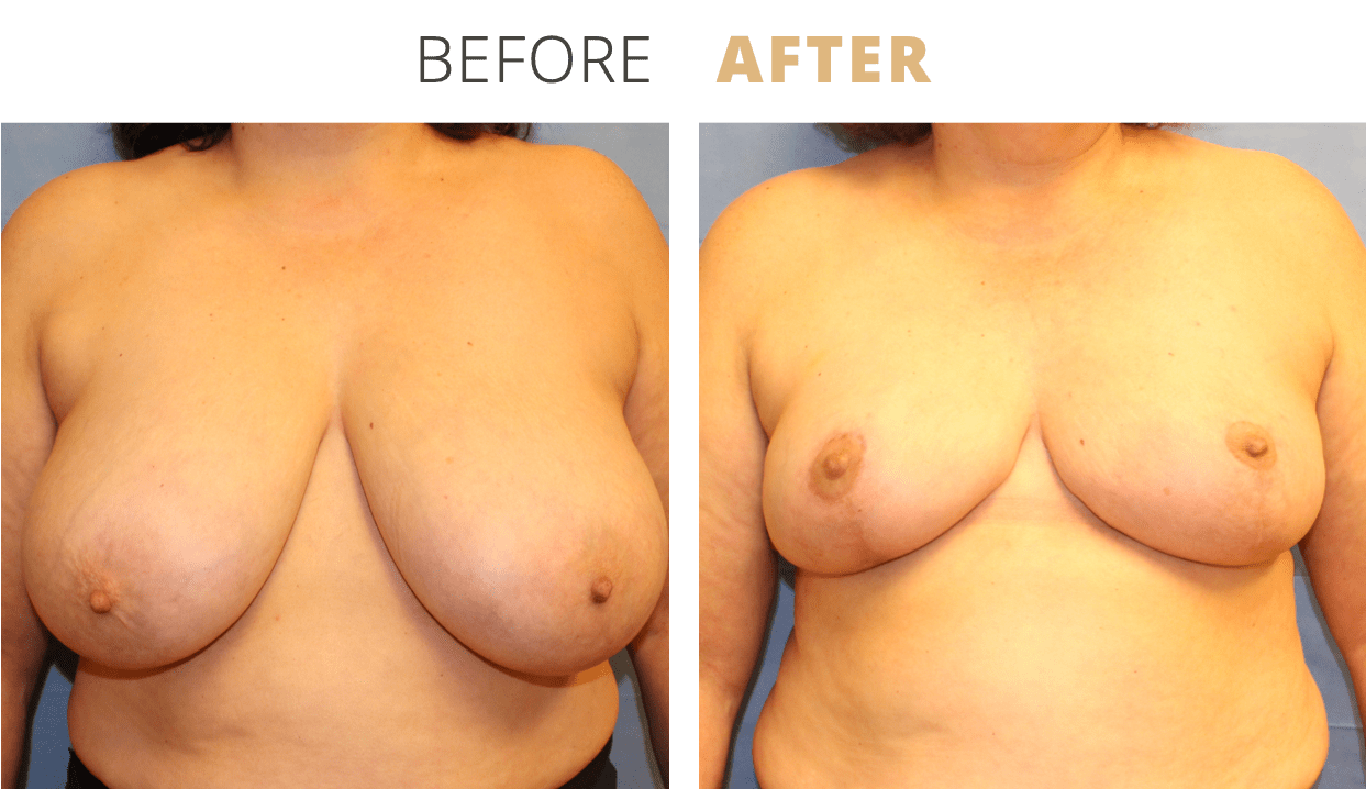 Breast-BreastReduction1
