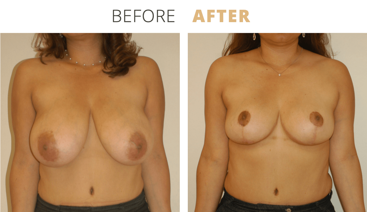 Breast-BreastReduction3