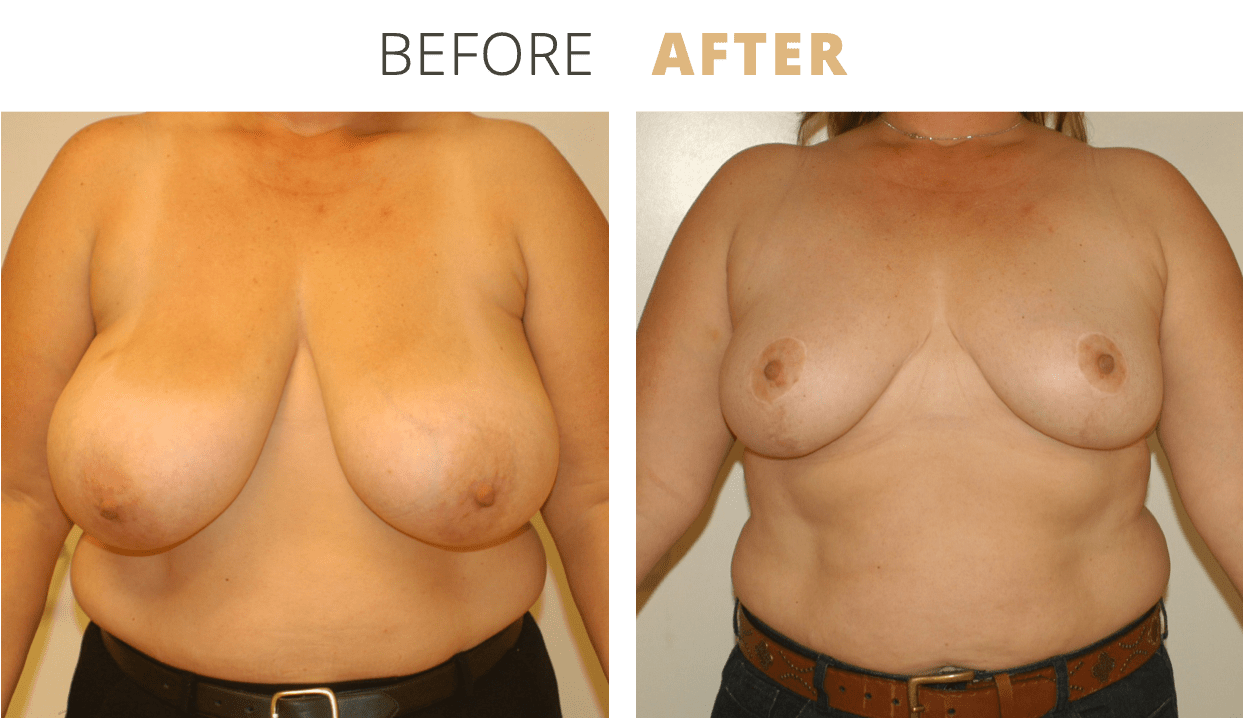 Breast-BreastReduction7
