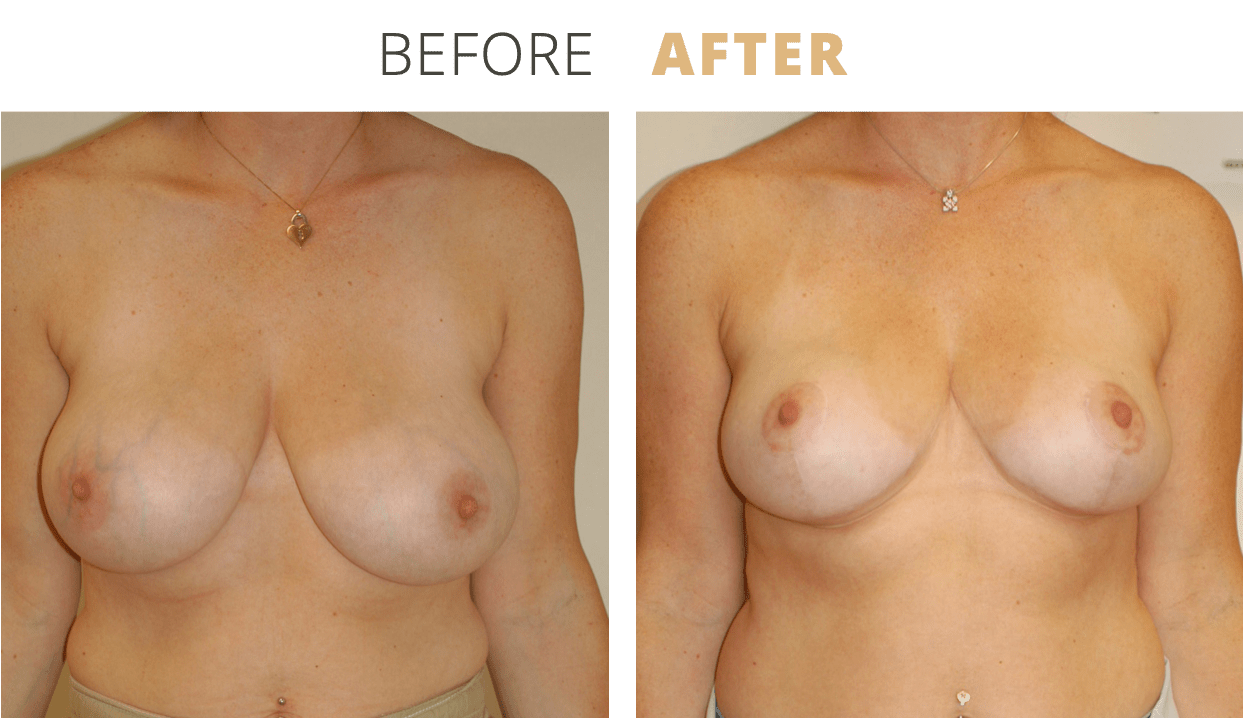 Breast-BreastReduction8
