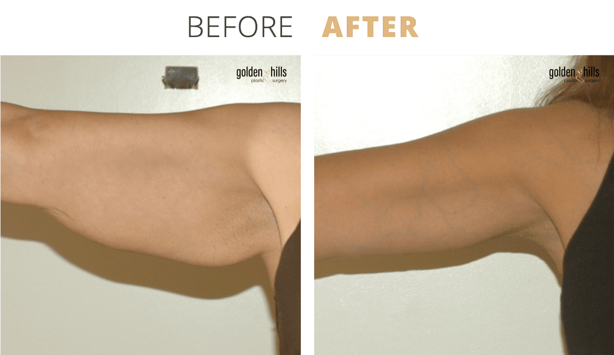 Body-Arm+Lift+(Brachioplasty)3
