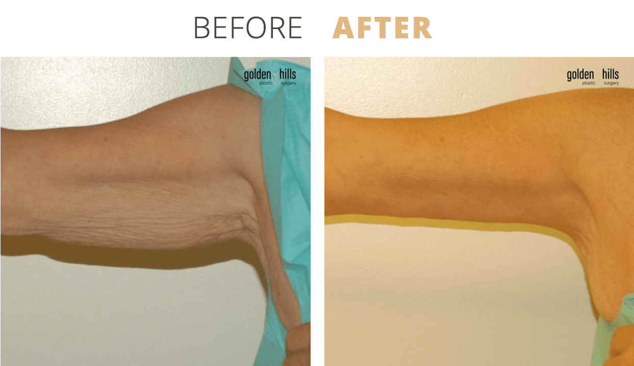 Body-Arm+Lift+(Brachioplasty)4