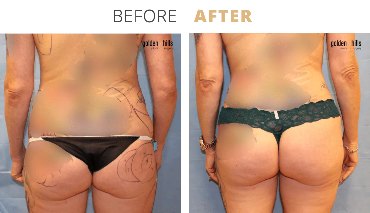 Body-Fat+Transfer+to+Buttocks+(Brazilian+Butt+Lift)1