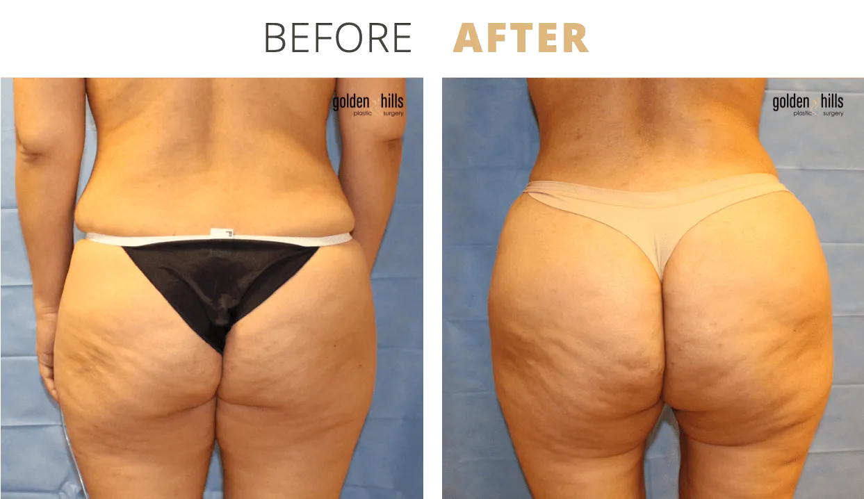 Body-Fat+Transfer+to+Buttocks+(Brazilian+Butt+Lift)3