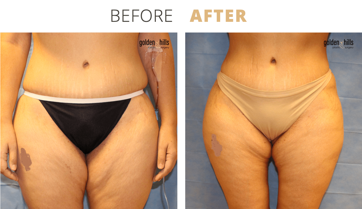 Body-Fat+Transfer+to+Buttocks+(Brazilian+Butt+Lift)5