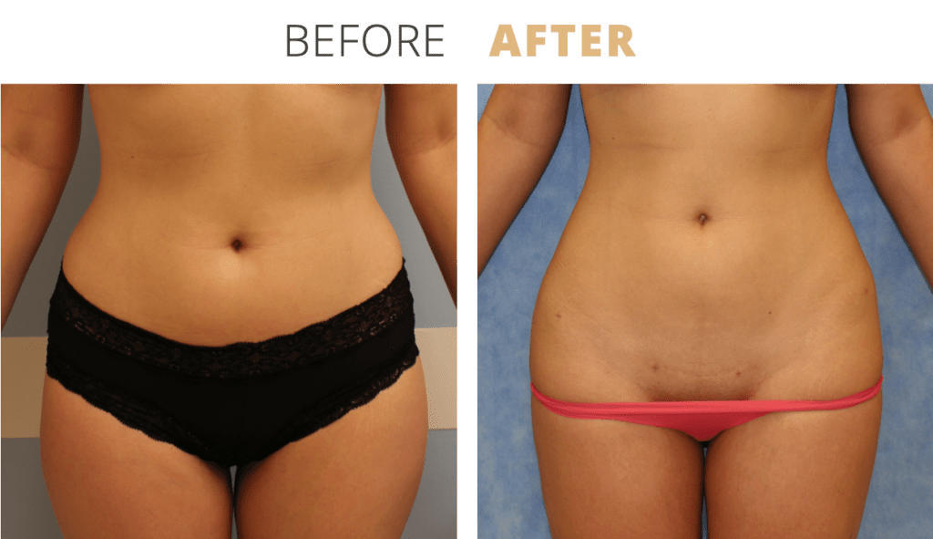 Body-Liposuction4-1-1024x591