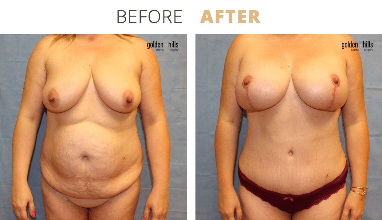 Body-Mommy+Makeover1