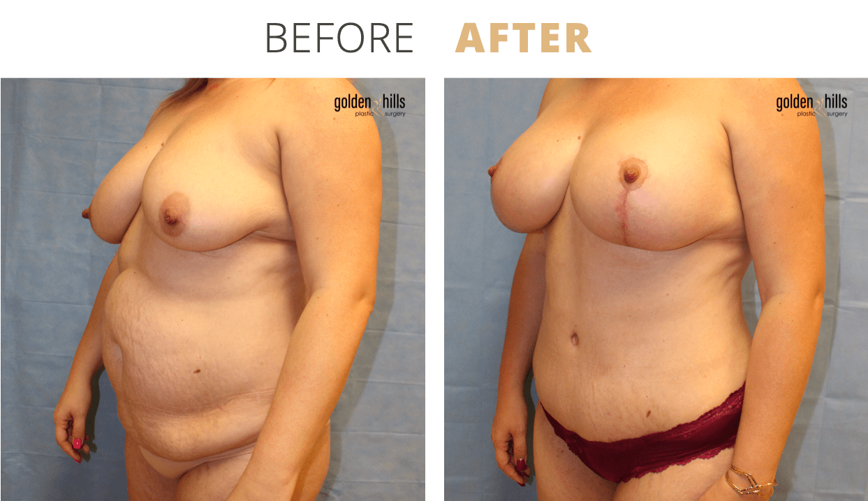 Body-Mommy+Makeover2