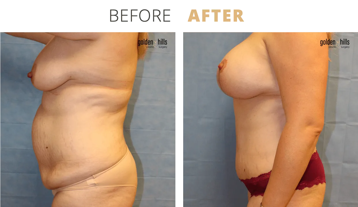 Body-Mommy+Makeover3