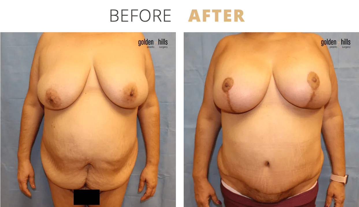 Body-Mommy+Makeover4