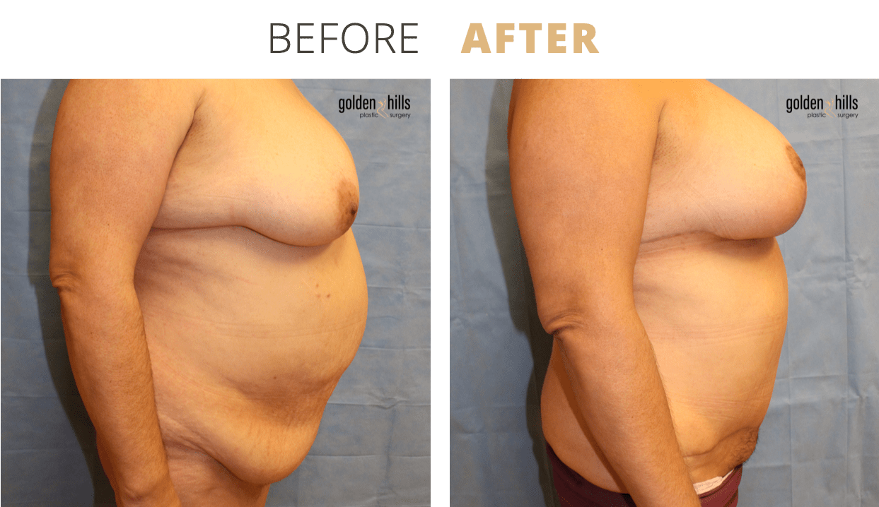 Body-Mommy+Makeover5