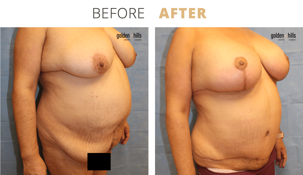 Body-Mommy+Makeover6