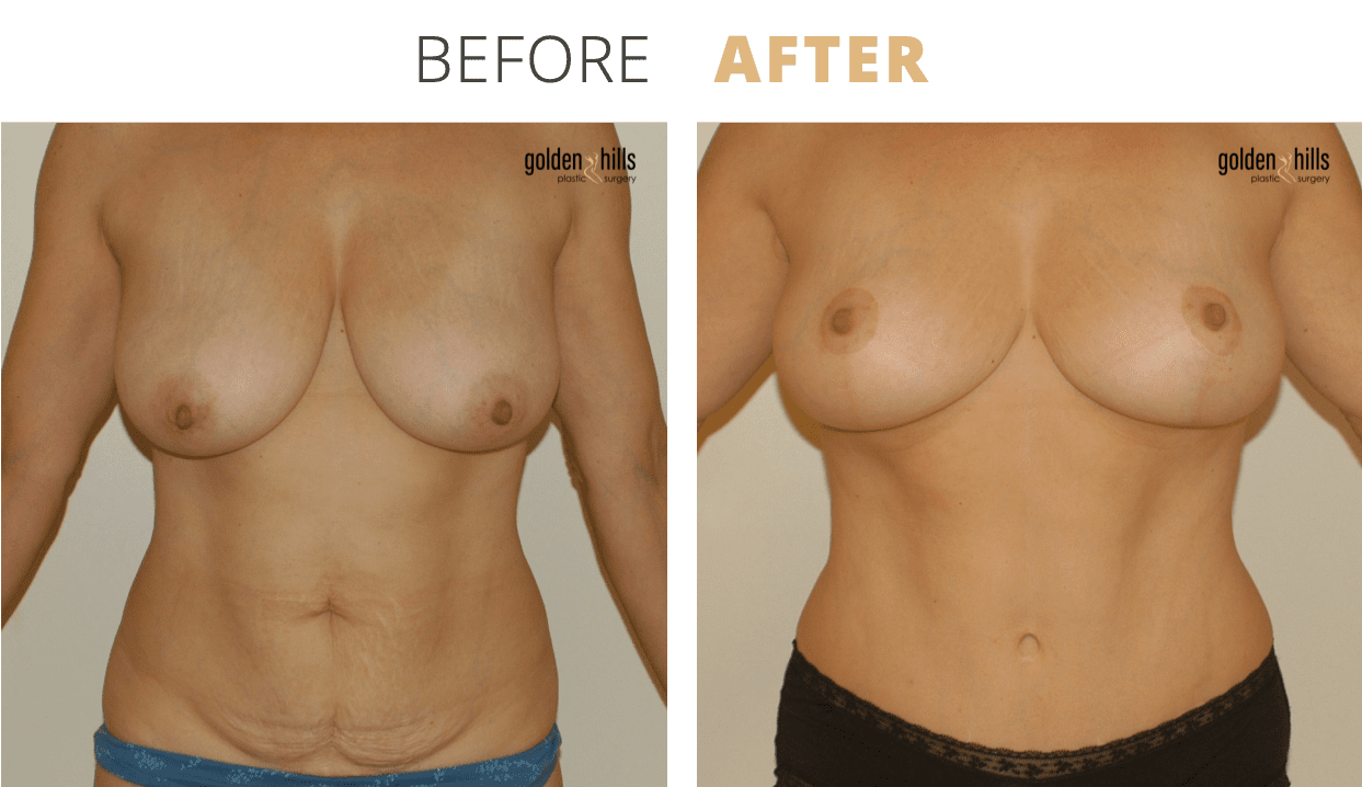 Body-Mommy+Makeover7