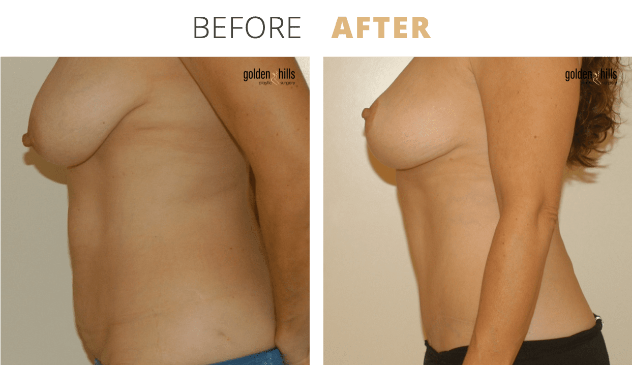 Body-Mommy+Makeover8