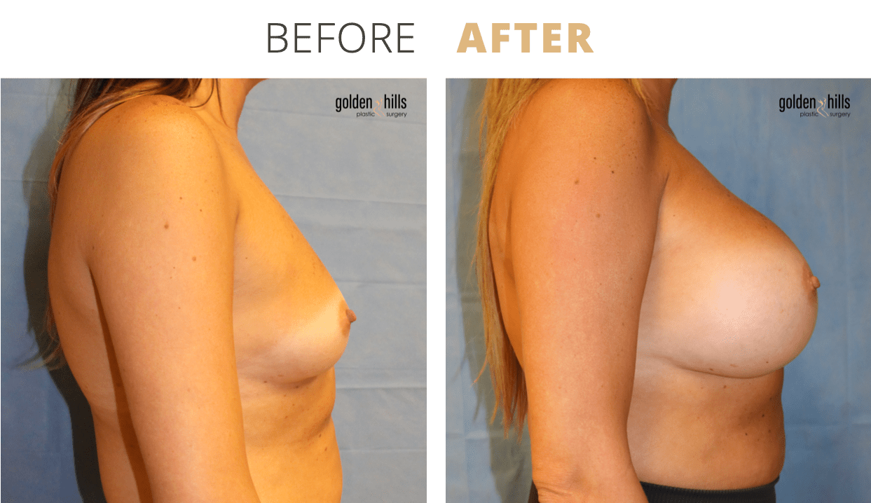 Breast-Breast+Augmentation10
