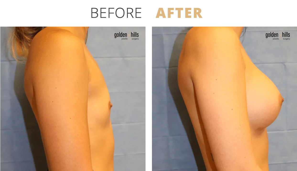 Breast-Breast+Augmentation2