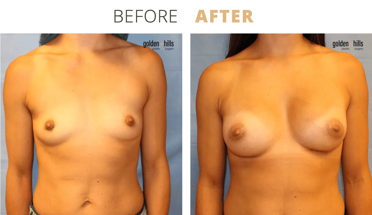 Breast-Breast+Augmentation3