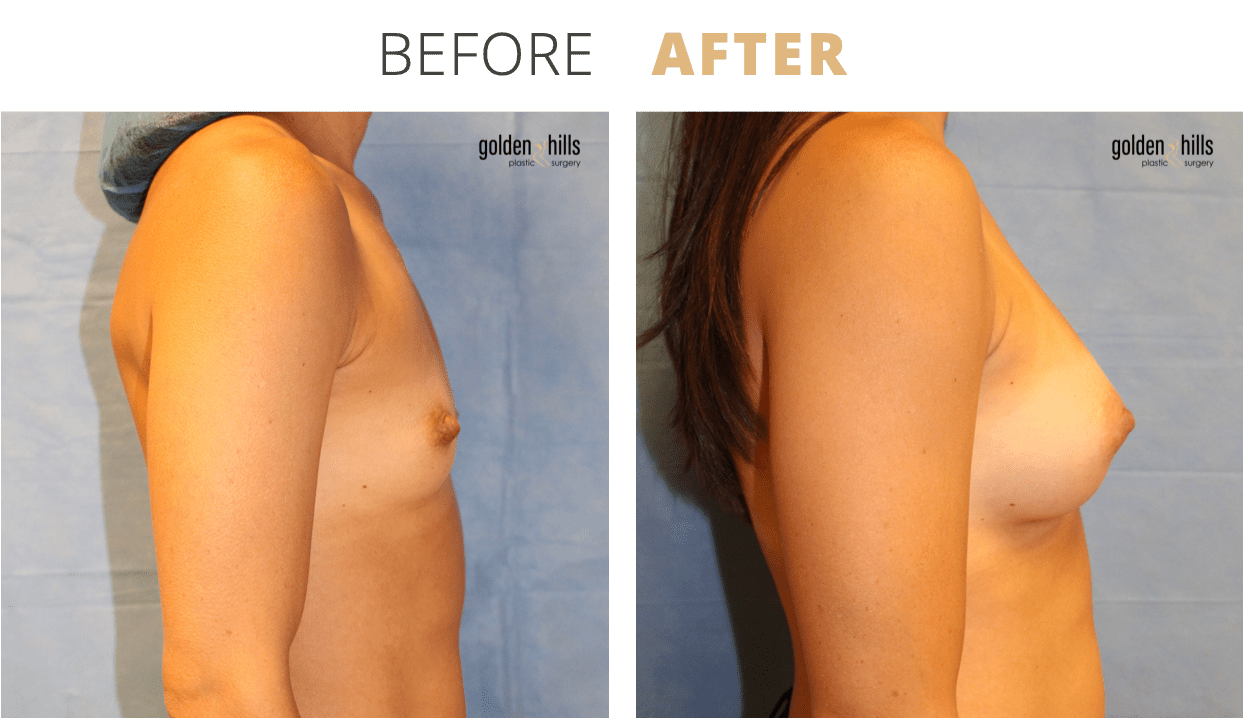 Breast-Breast+Augmentation4