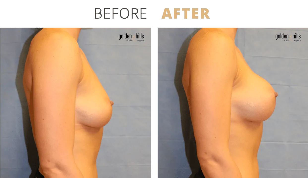 Breast-Breast+Augmentation5