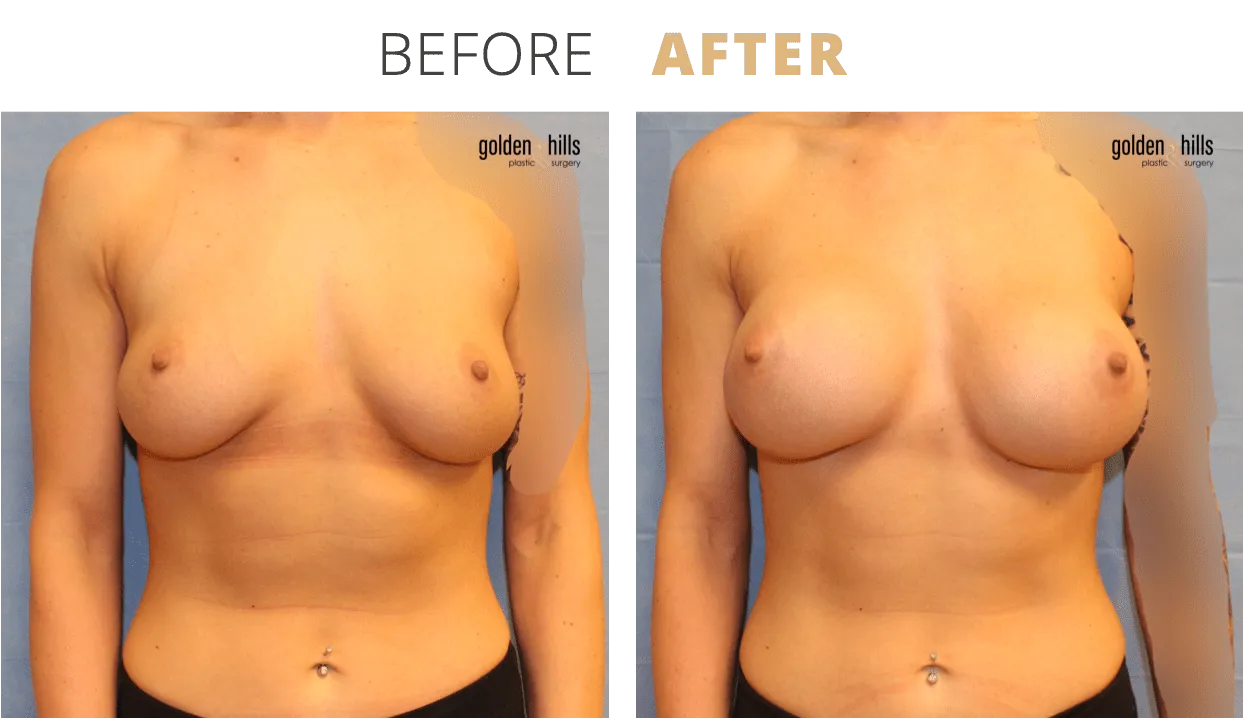 Breast-Breast+Augmentation6